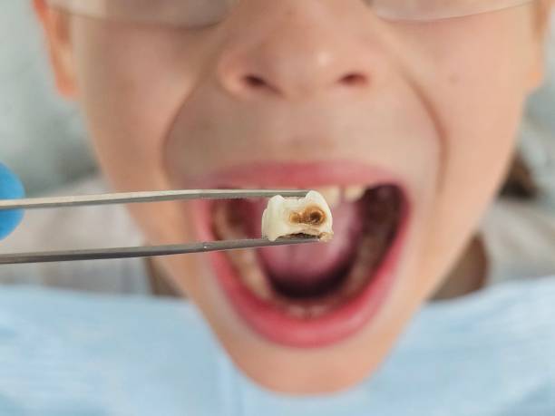 Best Urgent Care for Lost Fillings or Crowns in Ogden, KS